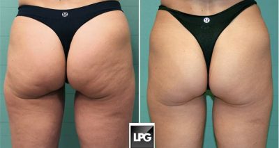 Remodelare Corporala